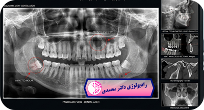 تفسیر عکس دندان در رادیوگرافی | دندانپزشک چه چیزهایی را تشخیص می‌دهد؟ | دکتر عباس محمدی مشهد