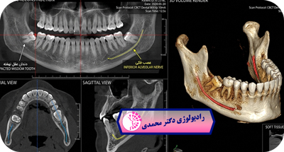 دندان عقل نهفته چیست؟ نقش CBCT و پانورکس در تشخیص و جراحی دندان عقل | دکتر عباس محمدی مشهد